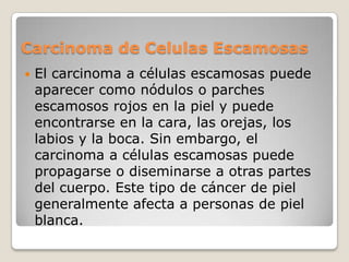 Carcinoma de Celulas EscamosasEl carcinoma a células escamosas puede aparecer como nódulos o parches escamosos rojos en la piel y puede encontrarse en la cara, las orejas, los labios y la boca. Sin embargo, el carcinoma a células escamosas puede propagarse o diseminarse a otras partes del cuerpo. Este tipo de cáncer de piel generalmente afecta a personas de piel blanca.