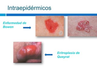 Intraepidérmicos

Enfermedad de
Bowen




                     Eritroplasia de
                     Queyrat
 