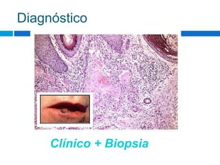 Diagnóstico




     Clínico + Biopsia
 