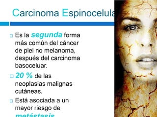 Carcinoma Espinocelular

   Es la segunda forma
    más común del cáncer
    de piel no melanoma,
    después del carcinoma
    basoceluar.
   20 % de las
    neoplasias malignas
    cutáneas.
   Está asociada a un
    mayor riesgo de
 