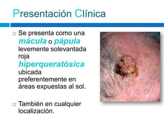 Presentación Clínica
   Se presenta como una
    mácula o pápula
    levemente solevantada
    roja
    hiperqueratósica
    ubicada
    preferentemente en
    áreas expuestas al sol.

   También en cualquier
    localización.
 