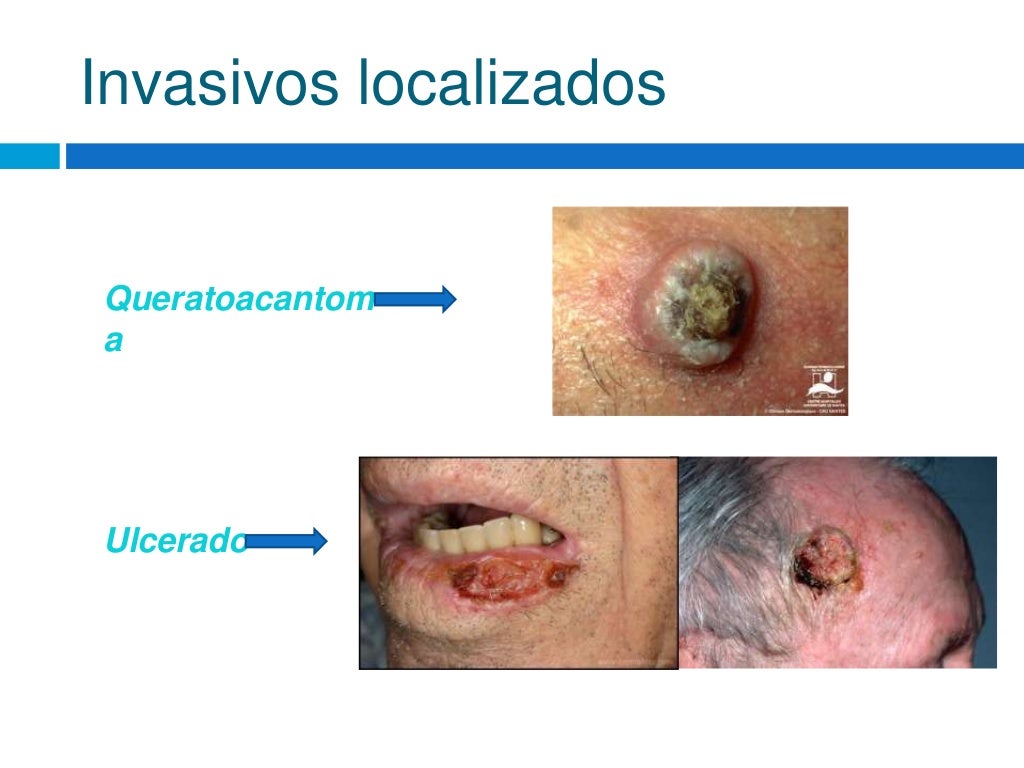 Carcinoma espinocelular