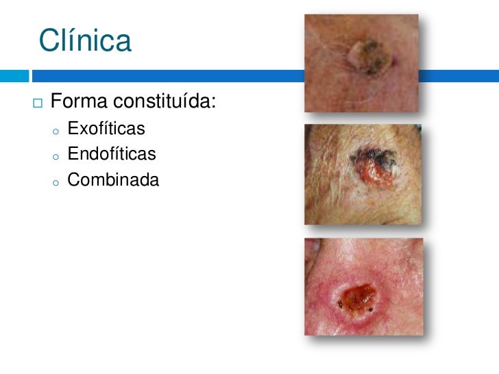 Carcinoma espinocelular