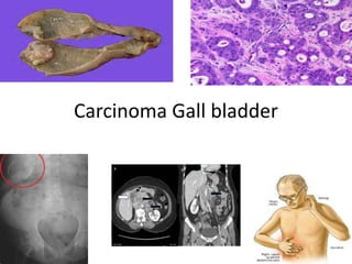 Carcinoma Gall bladder
 