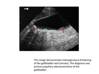 This image demonstrates heterogeneous thickening
of the gallbladder wall (arrows). The diagnosis was
primary papillary adenocarcinoma of the
gallbladder.
 