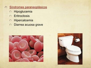 Síndromes paraneoplásicos
Hipoglucemia
Eritrocitosis
Hipercalcemia
Diarrea acuosa grave
 