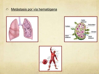 Metástasis por vía hematógena
 