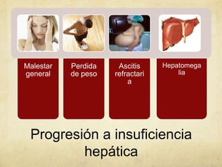Progresión a insuficiencia
hepática
Malestar
general
Perdida
de peso
Ascitis
refractari
a
Hepatomega
lia
 