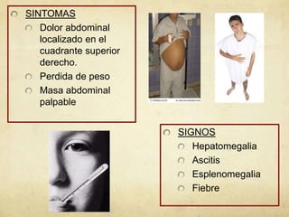 SINTOMAS
Dolor abdominal
localizado en el
cuadrante superior
derecho.
Perdida de peso
Masa abdominal
palpable
SIGNOS
Hepatomegalia
Ascitis
Esplenomegalia
Fiebre
 