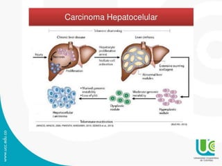 Carcinoma hepatocelular caso clinico