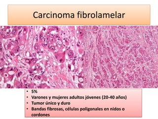 Carcinoma fibrolamelar

•
•
•
•

5%
Varones y mujeres adultos jóvenes (20-40 años)
Tumor único y duro
Bandas fibrosas, células poligonales en nidos o
cordones

 