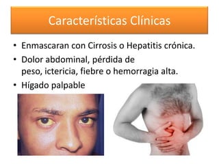 Características Clínicas
• Enmascaran con Cirrosis o Hepatitis crónica.
• Dolor abdominal, pérdida de
peso, ictericia, fiebre o hemorragia alta.
• Hígado palpable

 