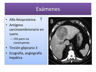 Exámenes
• Alfa-fetoproteína:
• Antígeno
carcinoembrionario en
suero.
– Útil pero no
concluyente.

• Tinción glipicano 3
• Ecografía, angiografía
hepática

 