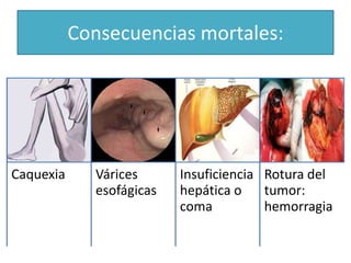 Consecuencias mortales:

Caquexia

Várices
esofágicas

Insuficiencia Rotura del
hepática o
tumor:
coma
hemorragia

 