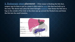 2. Endoscopic stent placement :- If the tumor is blocking the bile duct,
surgery may be done to put in a stent (a thin tube) to drain bile that has built up in
the area. The doctor may place the stent through a catheter that drains the bile into a
bag on the outside of the body or the stent may go around the blocked area and drain
the bile into the small intestine.
 