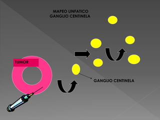 TUMOR
GANGLIO CENTINELA
MAPEO LINFATICO
GANGLIO CENTINELA
 