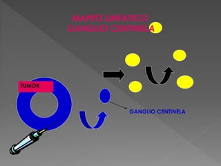 TUMOR
GANGLIO CENTINELA
MAPEO LINFATICO
GANGLIO CENTINELA
 