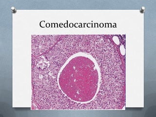 Comedocarcinoma