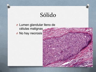 SólidoLumen glandular lleno de células malignasNo hay necrosis