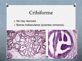 CribiformeNo hay necrosisBarras trabeculares (puentes romanos)