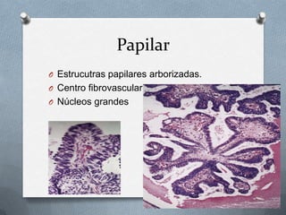 PapilarEstrucutras papilares arborizadas.Centro fibrovascularNúcleos grandes