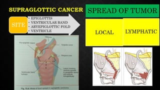 SUPRAGLOTTIC CANCER
• EPIGLOTTIS
• VENTRICULAR BAND
• ARYEPIGLOTTIC FOLD
• VENTRICLE
SITE
SPREAD OF TUMOR
LOCAL LYMPHATIC
 