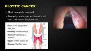 GLOTTIC CANCER
• Most commonly involved
• Free edge and upper surface of vocal
cord is the most frequent site
 
