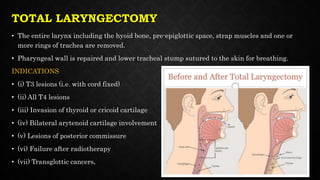 TOTAL LARYNGECTOMY
• The entire larynx including the hyoid bone, pre-epiglottic space, strap muscles and one or
more rings of trachea are removed.
• Pharyngeal wall is repaired and lower tracheal stump sutured to the skin for breathing.
INDICATIONS
• (i) T3 lesions (i.e. with cord fixed)
• (ii) All T4 lesions
• (iii) Invasion of thyroid or cricoid cartilage
• (iv) Bilateral arytenoid cartilage involvement
• (v) Lesions of posterior commissure
• (vi) Failure after radiotherapy
• (vii) Transglottic cancers,
 