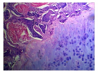 Spindle cell carcinoma
 