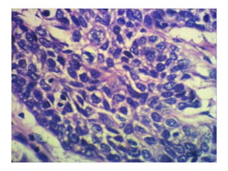 Basaloid squamous cell carcinoma
 