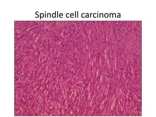 Carcinoma larynx   Slide 29