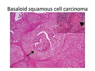 Carcinoma larynx   Slide 31