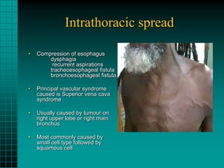 Intrathoracic spread

•   Compression of esophagus
        dysphagia
         recurrent aspirations
        tracheoesophageal fistula
        bronchoesophageal fistula

•   Principal vascular syndrome
    caused is Superior vena cava
    syndrome

•   Usually caused by tumour on
    right upper lobe or right main
    bronchus

•   Most commonly caused by
    small cell type followed by
    squamous cell
 