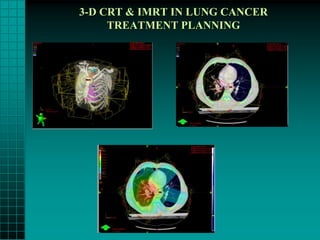 3-D CRT & IMRT IN LUNG CANCER
     TREATMENT PLANNING
 