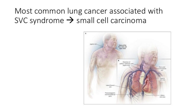 Carcinoma Lung Revision Notes