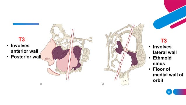 Carcinoma maxilla.pptx | Ear, Nose and Throat Conditions | Diseases and ...