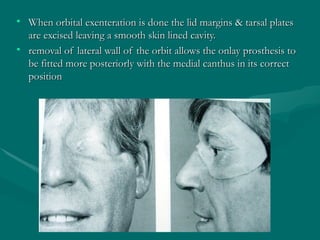 CARCINOMA MAXILLA clinical features and managment.ppt