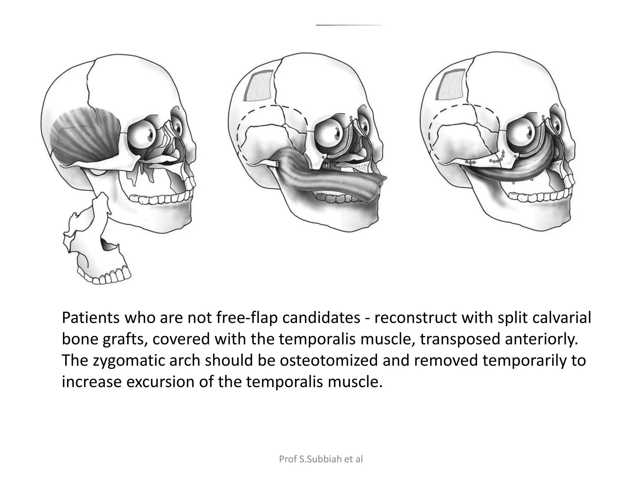 Carcinoma Maxillary sinus | PPTX