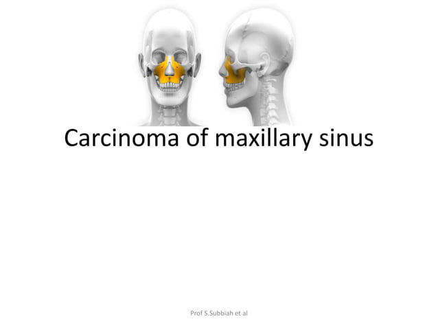 Carcinoma Maxillary sinus | PPTX