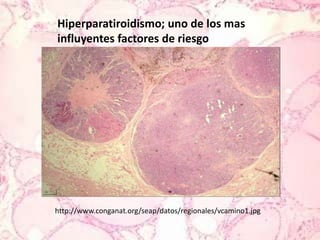 Hiperparatiroidismo; uno de los mas influyentes factores de riesgohttp://www.conganat.org/seap/datos/regionales/vcamino1.jpg