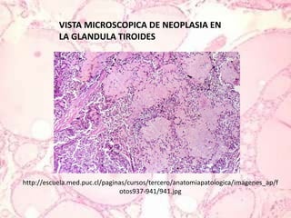 VISTA MICROSCOPICA DE NEOPLASIA EN LA GLANDULA TIROIDEShttp://escuela.med.puc.cl/paginas/cursos/tercero/anatomiapatologica/imagenes_ap/fotos937-941/941.jpg
