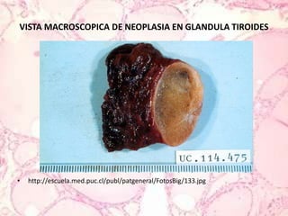 VISTA MACROSCOPICA DE NEOPLASIA EN GLANDULA TIROIDEShttp://escuela.med.puc.cl/publ/patgeneral/FotosBig/133.jpg