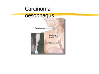 Carcinoma
oesophagus
 
