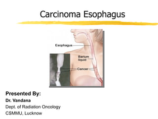 Carcinoma Esophagus




Presented By:
Dr. Vandana
Dept. of Radiation Oncology
CSMMU, Lucknow
 