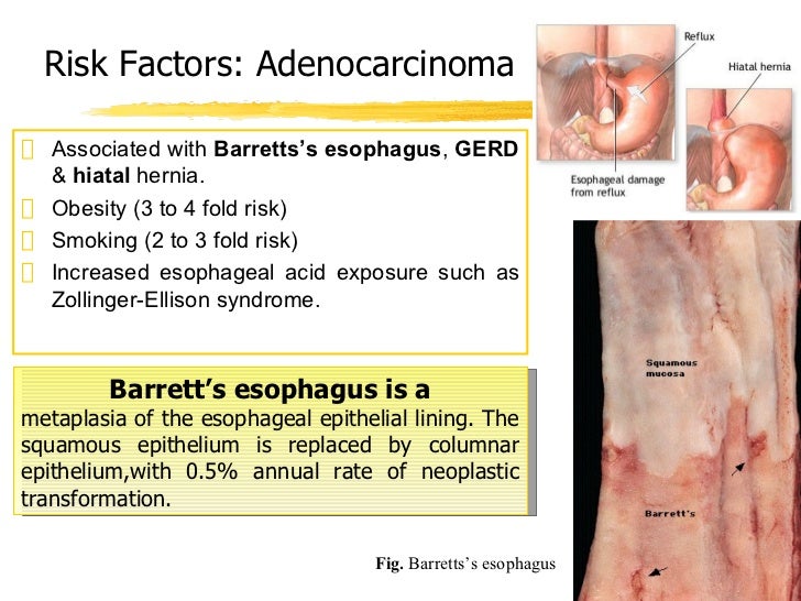 Barrett's Esophagus Stages