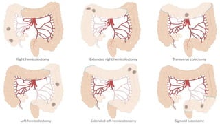 CARCINOMA OF CAECUM and treatment of lower GI cancers.pptx