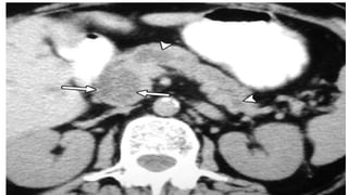 Comprehensive Overview of Pancreatic Carcinoma: Diagnosis and ...