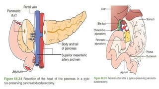 Comprehensive Overview of Pancreatic Carcinoma: Diagnosis and ...