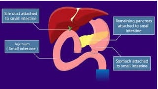 Comprehensive Overview of Pancreatic Carcinoma: Diagnosis and ...