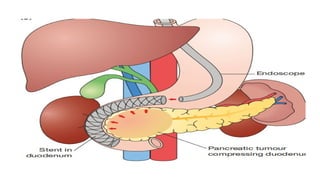 Comprehensive Overview of Pancreatic Carcinoma: Diagnosis and ...